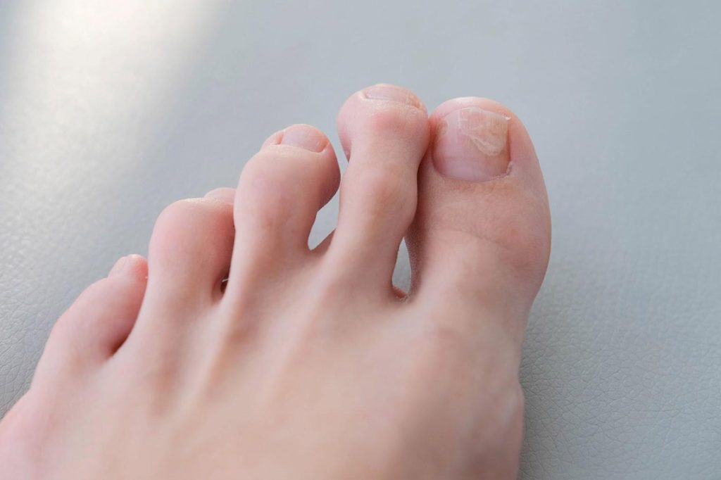 toenail fungus treatment singapore